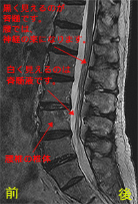 퍘